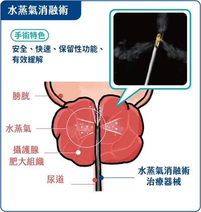 攝護腺肥大治療新選擇 十分鐘微創 水蒸氣消融手術