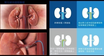 腎動脈交感神經阻斷術圖示。來源：高血壓導管治療衛教網