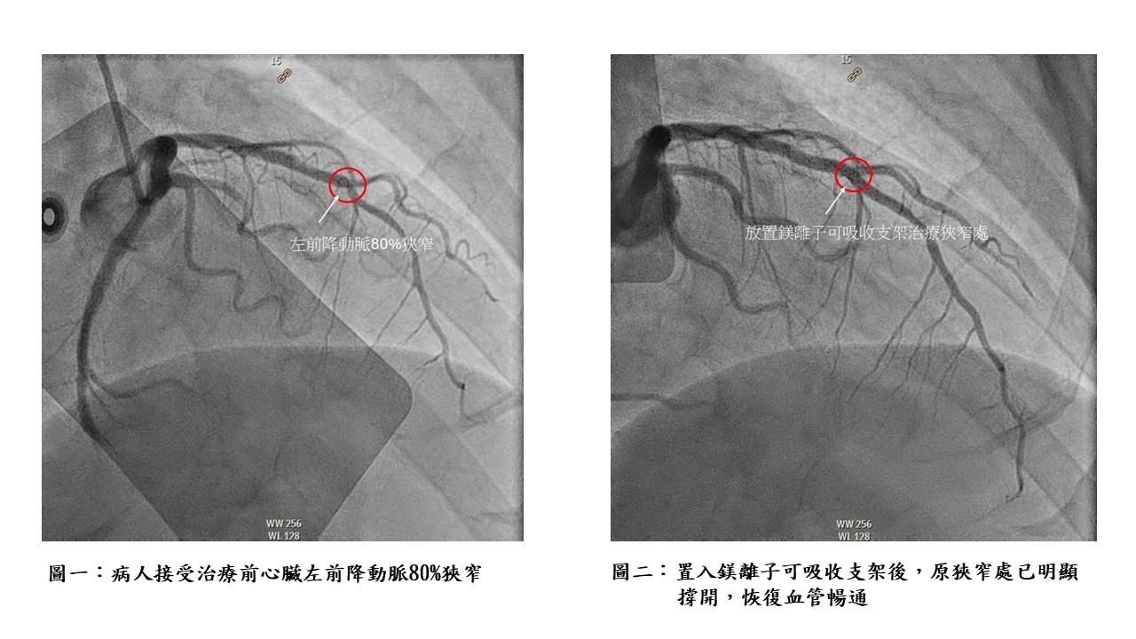 圖片：置入鎂離子可吸收支架後，原狹窄處已明顯撐開，恢復血管暢通