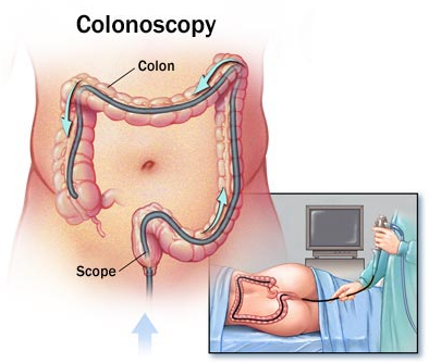 下消化道內視鏡檢查 (Colonoscopy)