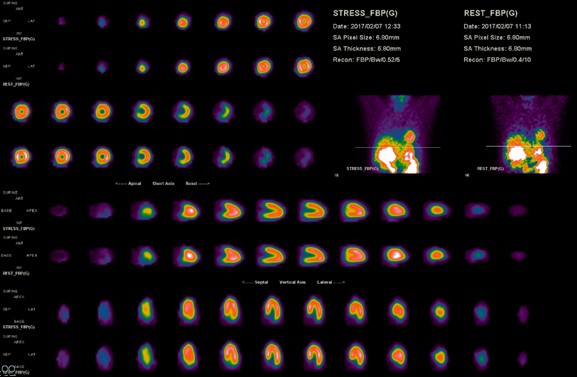 心肌動態灌注掃描-1