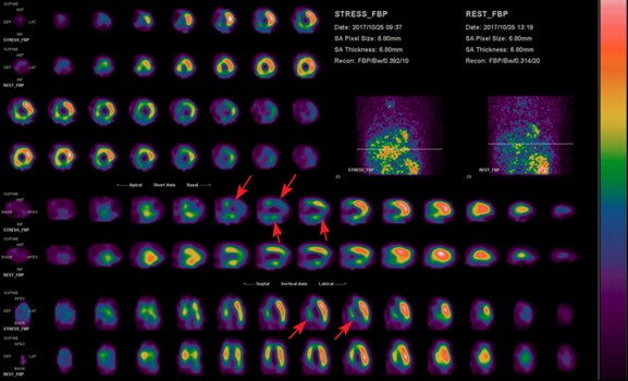 心肌動態灌注掃描-2