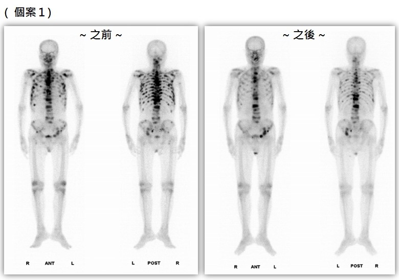 核醫-骨骼個案1