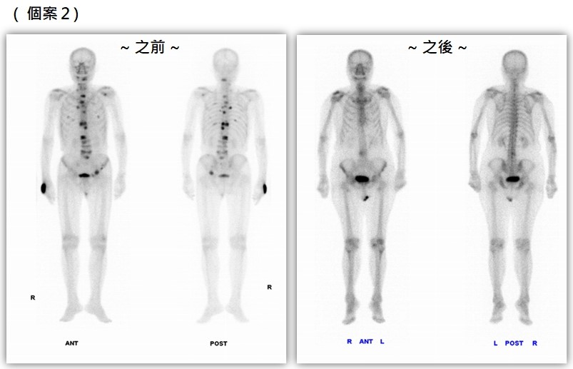 核醫-骨骼個案2